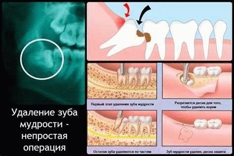 Реабилитация после удаления зуба