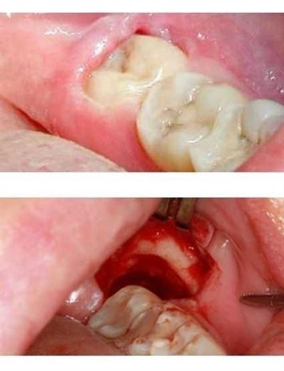 Вызов врача на дом после удаления зуба