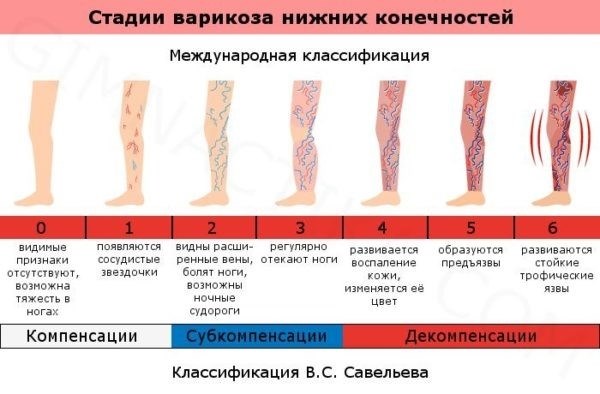 Отсрочка при варикозном расширении ног