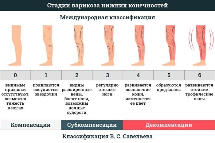 Стадии варикозной болезни